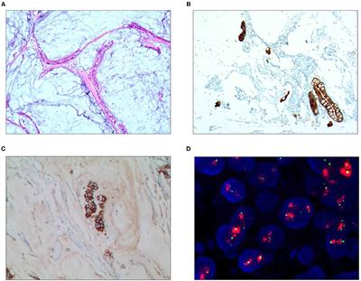 Research on the Histological Features and Pathological Types of Gastric Adenocarcinoma With Mucinous Differentiation